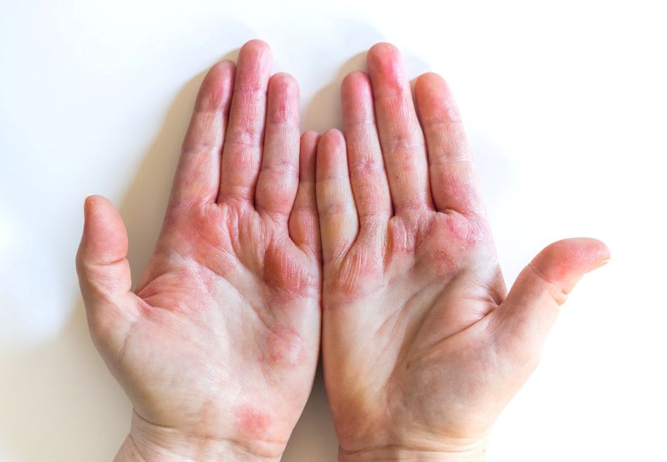 eczema on someone's hands